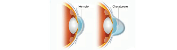 Cheratocono